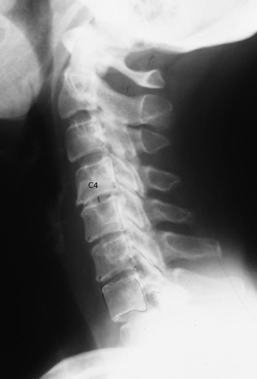 Military Neck with Anterior Syndrome from Palmer Chiropractic in
